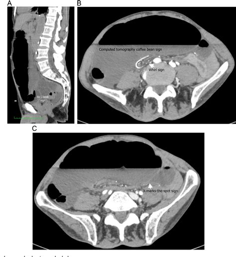 Figure 1 from Reversed midgut rotation revealed by cecal volvulus in ...