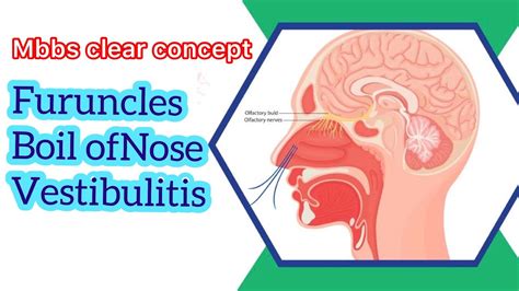 Furuncles | Boil of Nose | Vestibulitis | Disease of nasal vestibules - YouTube