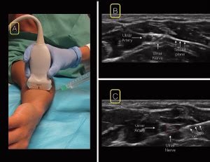 Figure 5. For the ulnar nerve block, position the linear ultrasound at the wrist over the ulnar ...