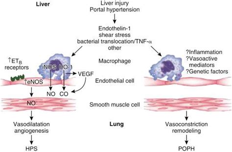 Portopulmonary Hypertension and Hepatopulmonary Syndrome - Clinical Tree