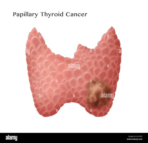 Labeled illustration showing papillary thyroid cancer, the most common ...