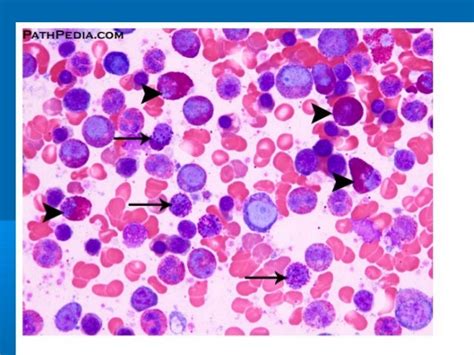 Wbc disorders