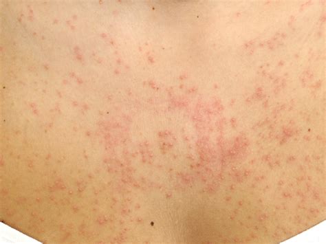 Pityrosporum folliculitis - Gistpuistjes - Chris Farrell - Kennisbank