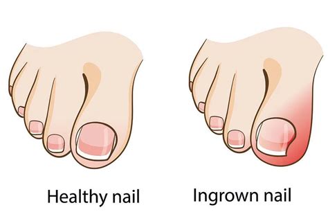 Ingrown Toenail - Is it Time To See a Podiatrist?