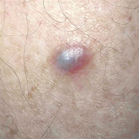 Firm, dark bluish nodular lesion, in more details. | Download ...