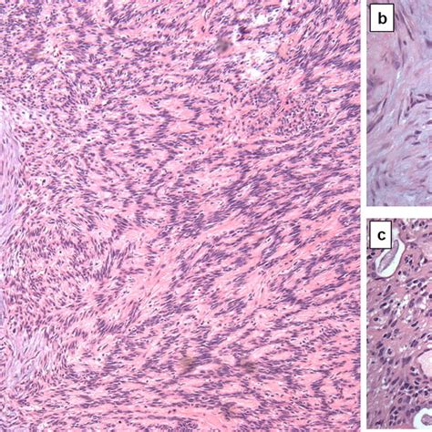 The histology and immunohistochemistry of the schwannoma-like areas of ...