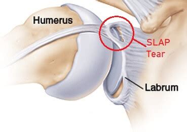 SLAP Tear: Causes, Symptoms & Treatment of the Shoulder (2023)