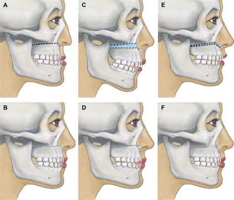 The Surgical Tools: The LeFort I, Bilateral Sagittal Split Osteotomy of the Mandible, and the ...