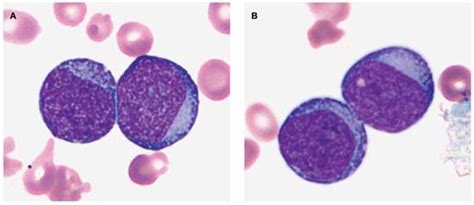 Patient’s peripheral blood smear illustrates (A) blasts with a RBC (drepanocyte) with a Howell ...