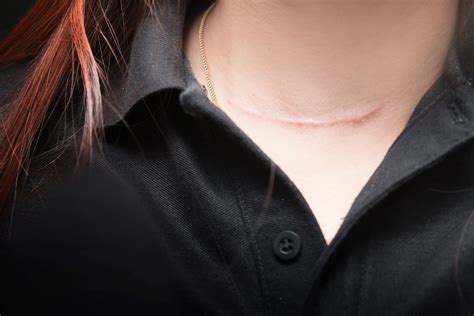 What Is the Value of a Scar from a Car Accident? | Max Meyers Law PLLC