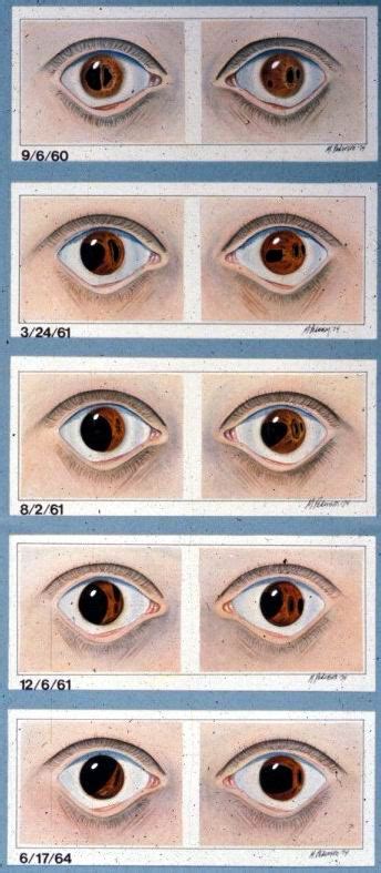 Axenfeld-Rieger Syndrome, Type 1 | Hereditary Ocular Diseases