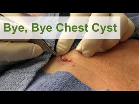 Bye, Bye Chest Cyst | Dr. Derm - YouTube