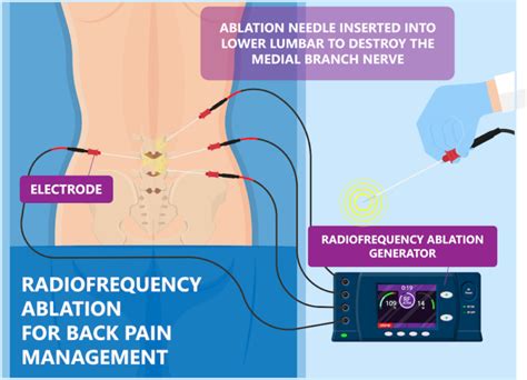 Radiofrequency Ablation | AllSpine Laser & Surgery Centers