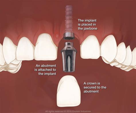 Dental Implants Clearfield, UT - Implant Dentistry - The Oral & Facial Surgery Center