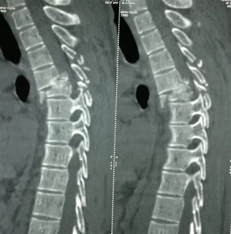 Feflow 6 2 Cracked Vertebrae - lasoparecovery