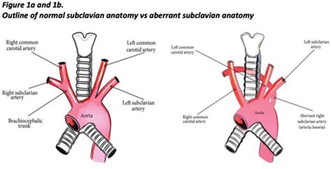 ABERRANT RIGHT SUBCLAVIAN ARTERY PRESENTING AS UPPER AIRWAY OBSTRUCTION ...