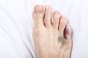 I Think My Toe Is Broken. What Should I Do? – Perform Podiatry