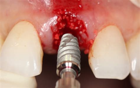 Surgical Placement of Dental Implants: A Restorative-Driven Approach - Glidewell Direct