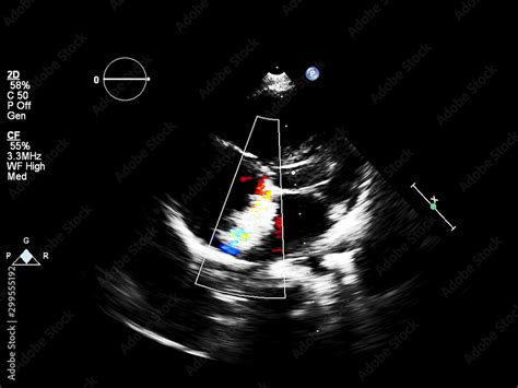 Screen of echocardiography (ultrasound) machine. Stock Photo | Adobe Stock