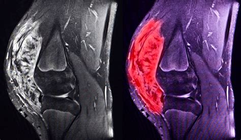 Musculoskeletal Expertise for Sarcoma Treatment - Vanderbilt Discover