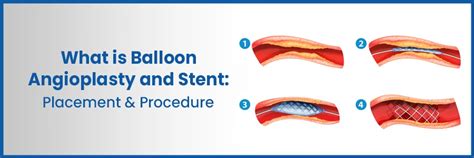 What is Balloon Angioplasty and Stent: Placement & Procedure