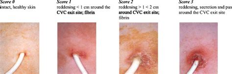 CVC exit-site skin infection score | Download Scientific Diagram