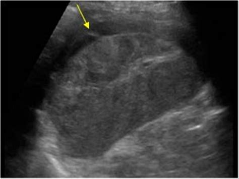 Abdomen and retroperitoneum | 1.4 Spleen : Case 1.4.7 Trauma of the spleen | Ultrasound Cases