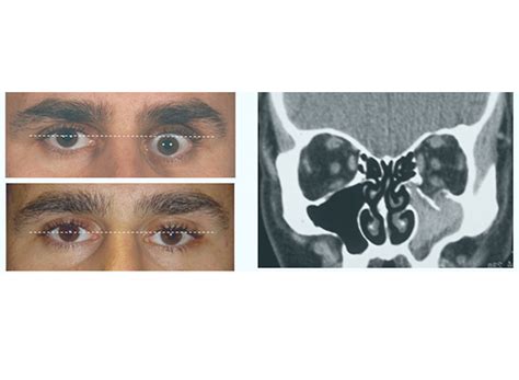 Orbital Fracture & Imaging | The DH Verity Eye Practice