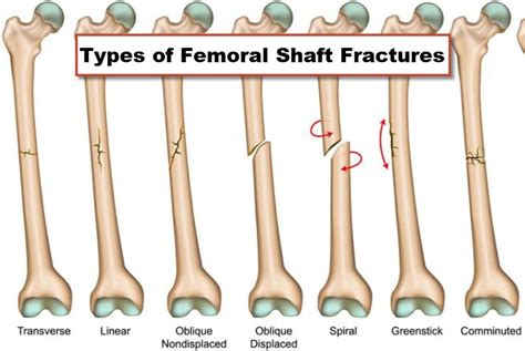 Femoral Shaft Fractures