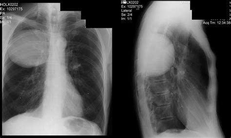 download Causes Of Bilateral Lung Crackles - photosblog71