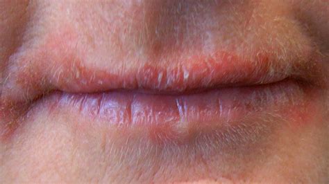 Bumps on Lips: Causes, Treatments, and More