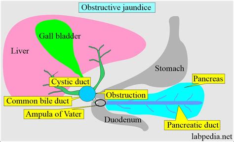 Urine Bilirubin, Bilirubinuria - Labpedia.net