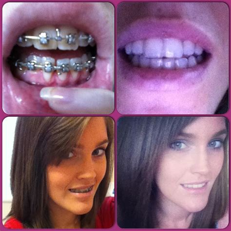 A Guide to Surviving Orthognathic Surgery: Before and After Jaw Surgery Images