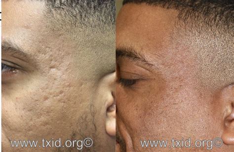 Do You Have Anything to Get Rid of Acne Scarring on African A merican ...