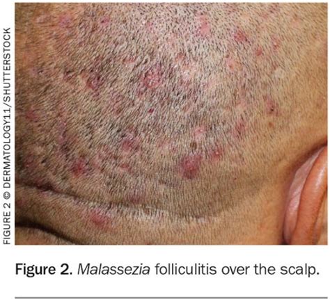 Folliculitis Scalp