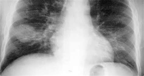 RADIOLOGY IMAGE SPOTTERS: Round pneumonia