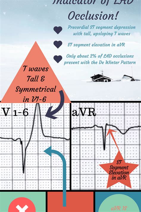 De Winter's Pattern | Ditch Doc EM