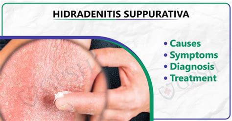 Hidradenitis Suppurativa: Causes, Symptoms, Diagnosis, and Treatment