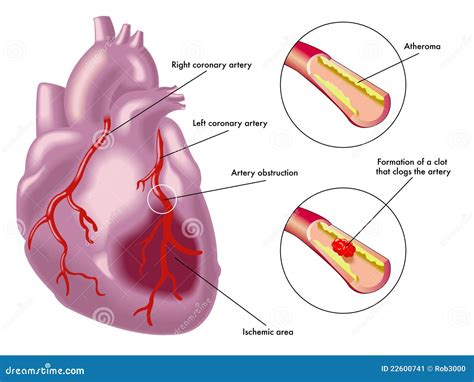 Myocardial infarction stock vector. Image of electrocardiogram - 22600741