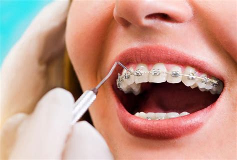 What Is Accelerated Orthodontics & Is It Safe? - Outstanding Ortho