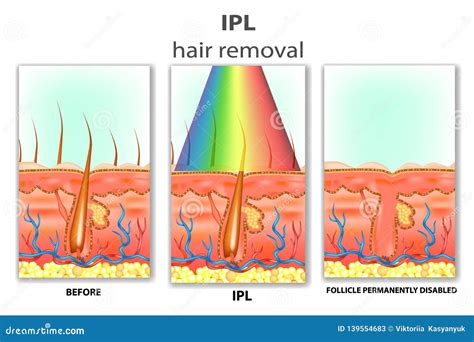 IPL Intense Pulsed Light stock vector. Illustration of skin - 139554683