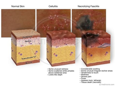 Necrotizing Fasciitis – Medmovie.com