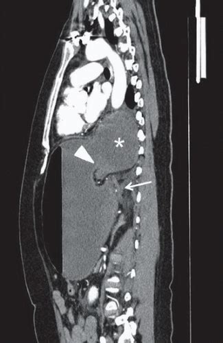 Gastric Volvulus | Radiology Key