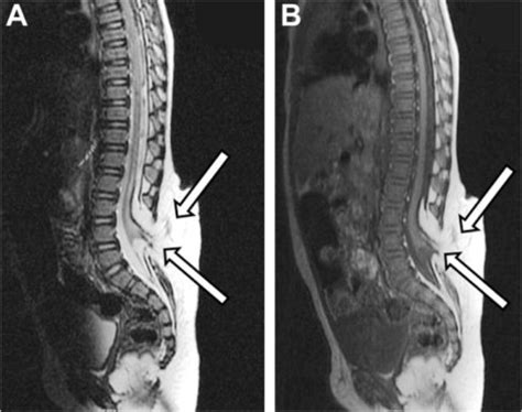 Spina Bifida Occulta Mri