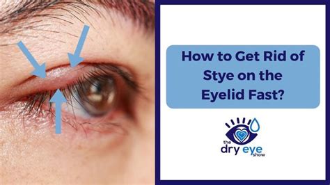 How To Get Rid Of Stye On Eyelid Fast - Latest News