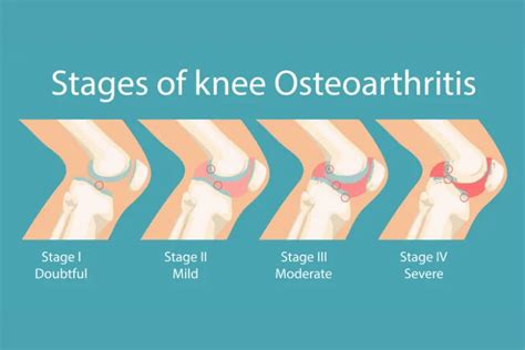 Signs & Symptoms of Osteoarthritis – ActiveBeat – Your Daily Dose of Health Headlines