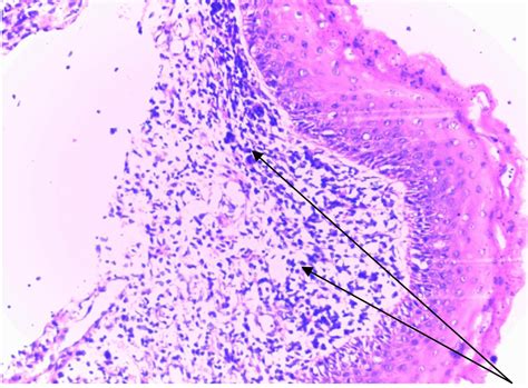 FULL TEXT - Sarcoma botryoides a management dilemma: A review of two ...