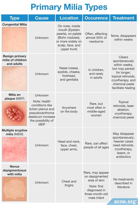 What Are Milia, and Do They Relate to Acne? - Acne.org