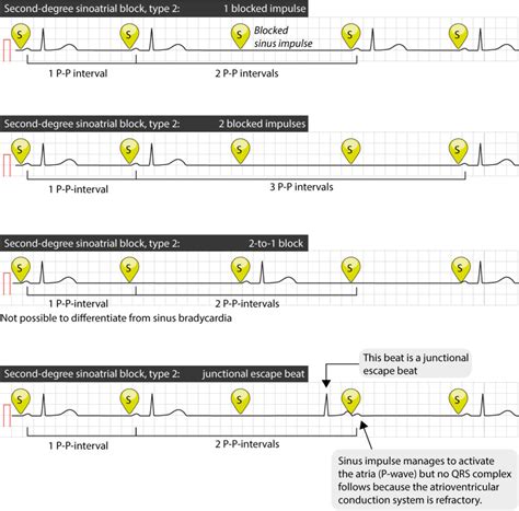 Sinoatrial block (SA block): ECG criteria, causes and clinical features – Cardiovascular Education