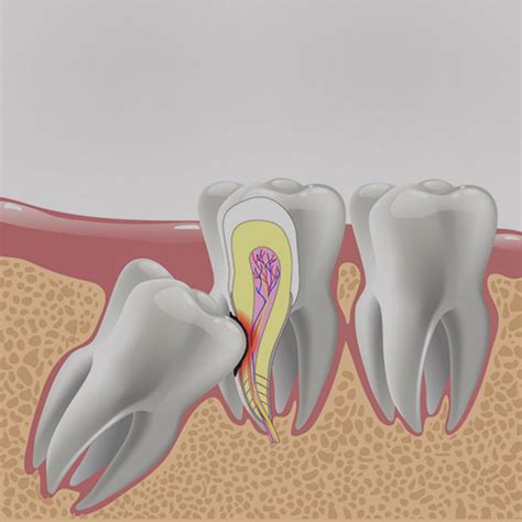 Abscessed Wisdom Tooth Extraction